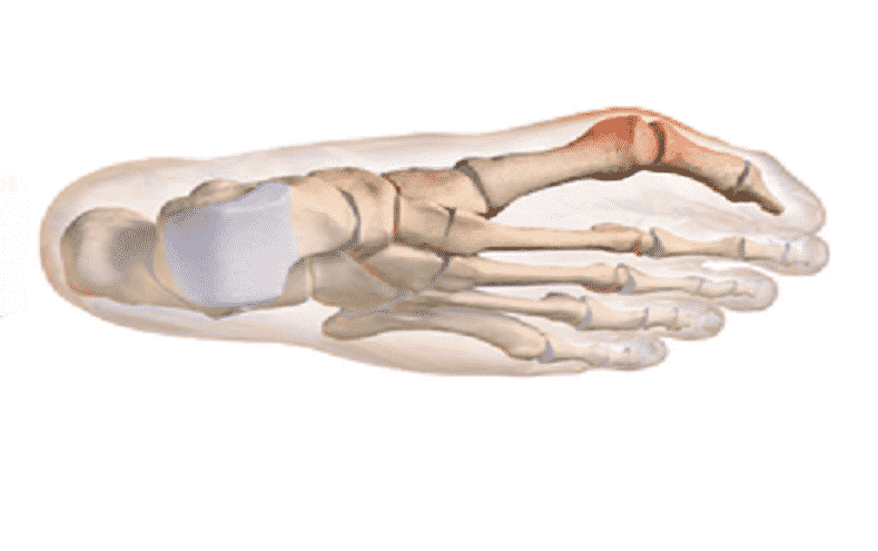 How To Treat A Bunion