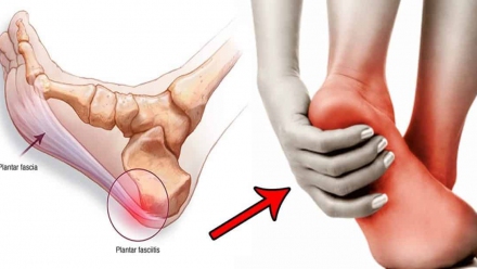 Plantar Fasciitis Illustration