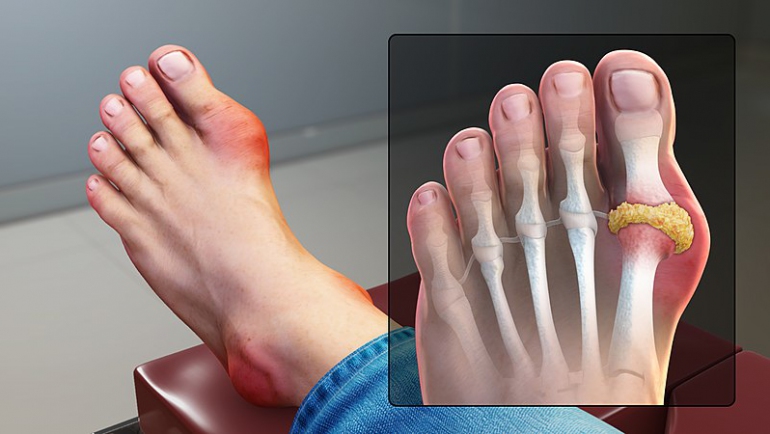 A leg with Gout