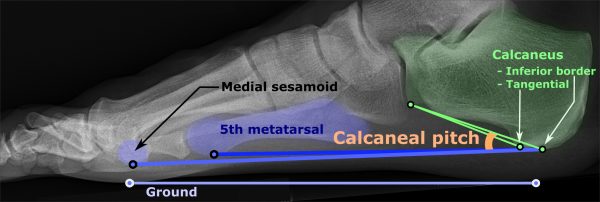 An X-Ray of a flat feet with explanations